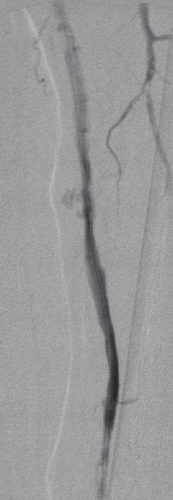Mid and distal parts of the SFA with thrombus