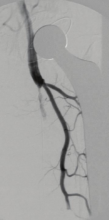 Case Reports in Vascular Medicine 3 (a) (b) (c) (d) (e) (f) Figure 3: During the second angiographic session, DSA reveals not only complete resolution of the thrombus in the