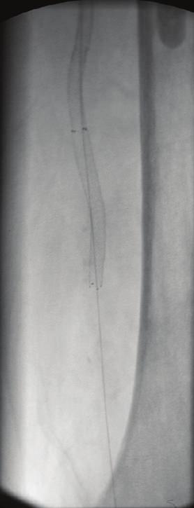 Subsequently, good angiographic flow can be achieved in the SFA and in the popliteal artery with a 1-vessel run-off of the anterior tibial artery ((c) (f)). aspirin and 5,000 I.