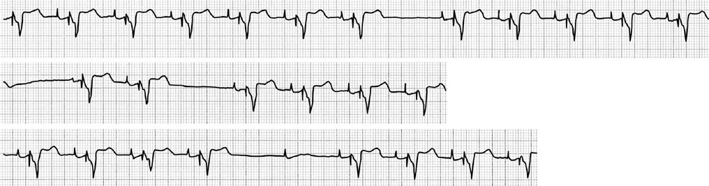 CAUSES OF ABSENCE OF PACEMAKER STIMULUS OUTPUT Normal inhibition by native atrial and ventricular events, or by oversensed signals, including electromagnetic interference Loose lead-generator
