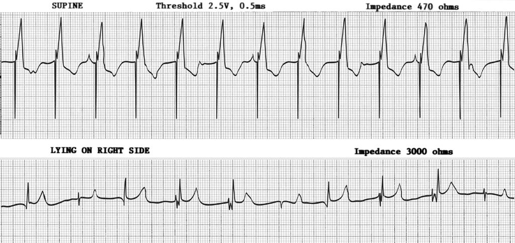 CAUSES OF RAPID VENTRICULAR PACED RATES* IN DDD PACEMAKERS Sinus tachycardia with normal tracking 