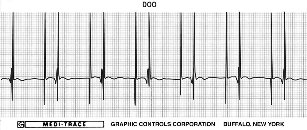 Are apparent noncapture episodes confirmed by multiple ECG leads?