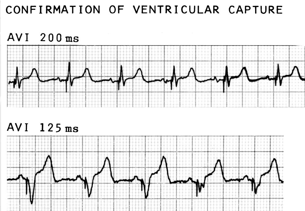 CONFIRMATION OF VENTRICULAR CAPTURE V Fusions AVI 200 ms V Fusions NOT ALL WIDE QRS COMPLEXES CAN BE