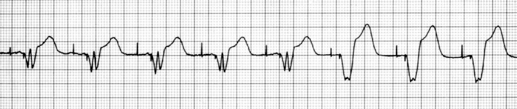mode, where the ECG reveals As function, loss of atrial capture is confirmed by the occurrence of