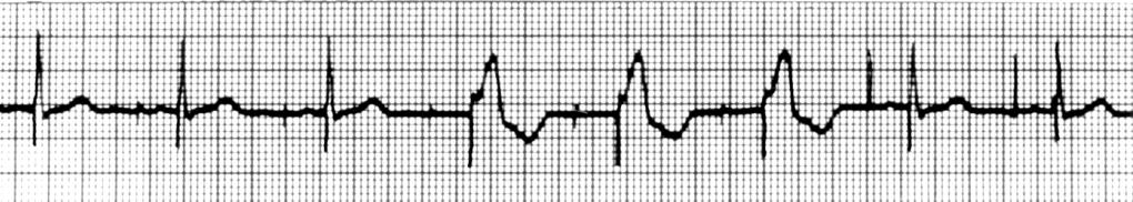 If AV pacing is occurring but the ventricular complexes are fusions, loss of atrial capture is