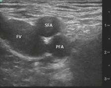 If the trifurcation of the popliteal vein is seen or if any smaller vessels are seen around the two main ones, then the probe is probably too distal and needs to be moved up.