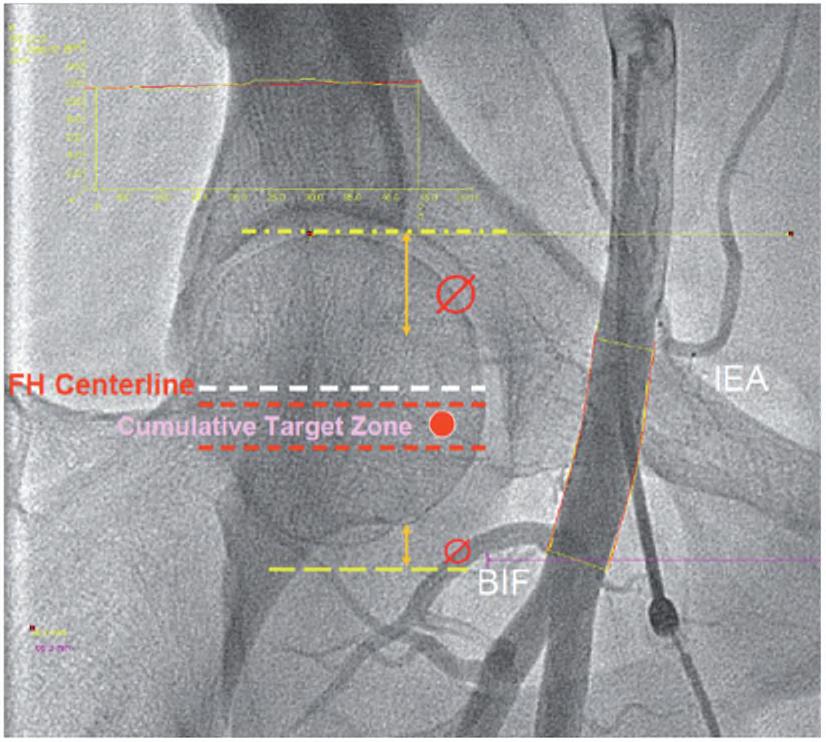 Common femoral Artery: anatomy Continuation of external iliac artery Crosses the
