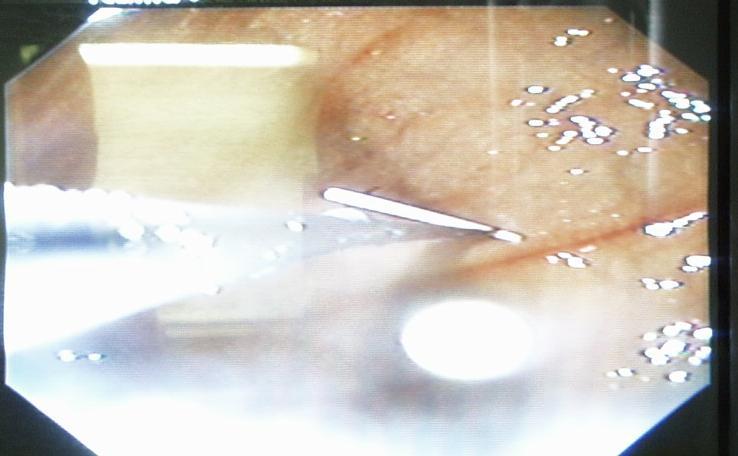 A stab incision of about 3mm in width
