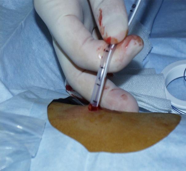 The tube and cannula are pulled together out of the abdominal