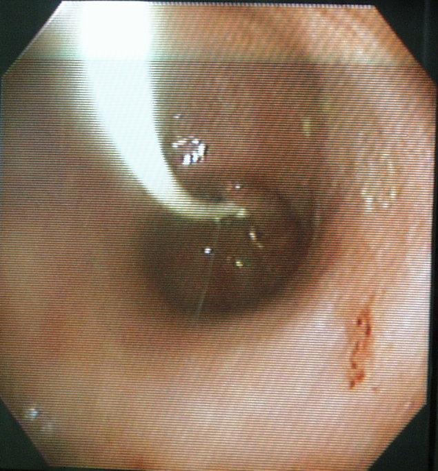 After the endoscope has been passed into the