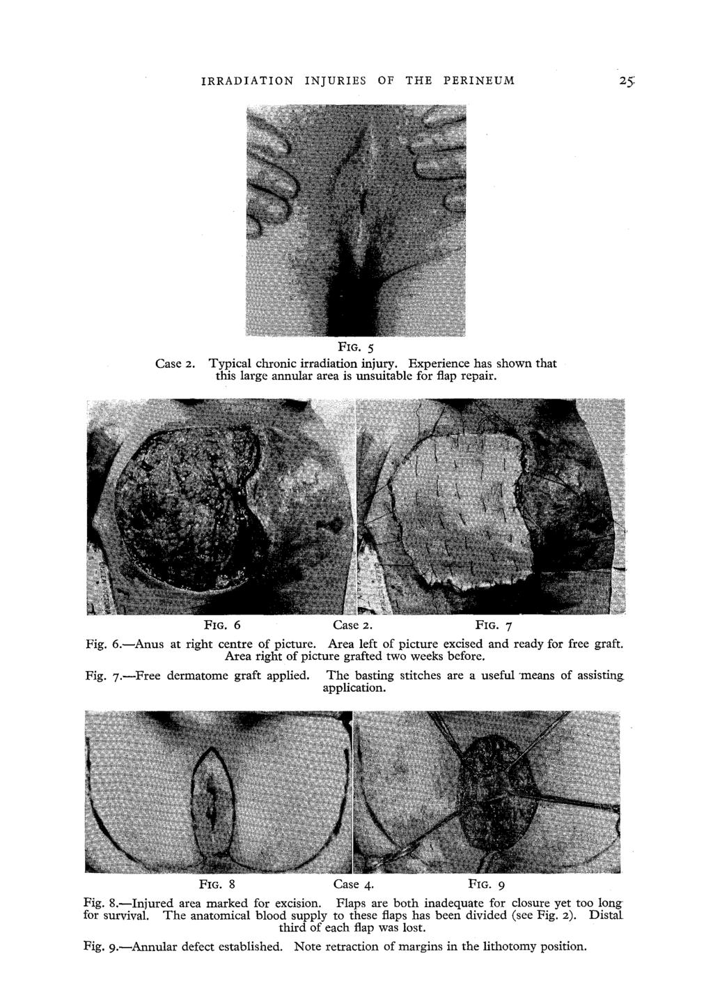 IRRADIATION C a s e 2. INJURIES OF THE PERINEUM 2~; FIG. 5 Typical chronic irradiation injury.