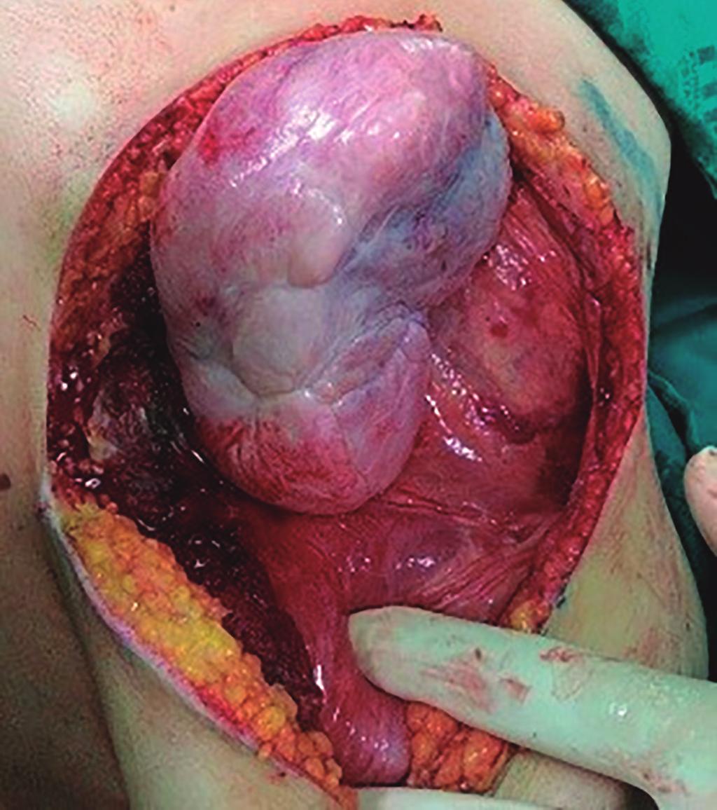 Aggressive fibromatosis (desmoid tumor) associated with breast implant Figure 19. Postoperative aspect. Figure 17. AF taking the form of a large tumor.