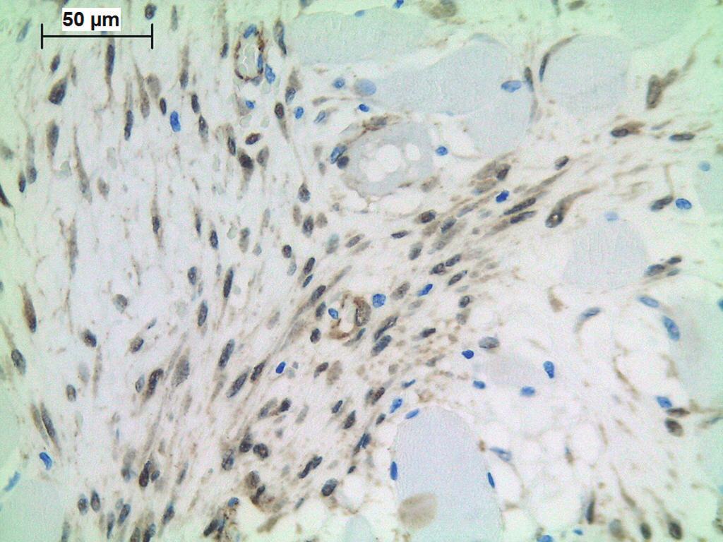 Among the collagen fibers, there are spindle-shaped cells with thin, conical nuclei at their extremities. Nuclei have no atypia and have a vesicular pattern of chromatin. The mitotic index is low.