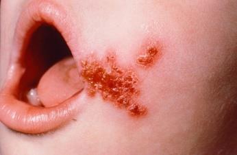 skin lesions Boils,