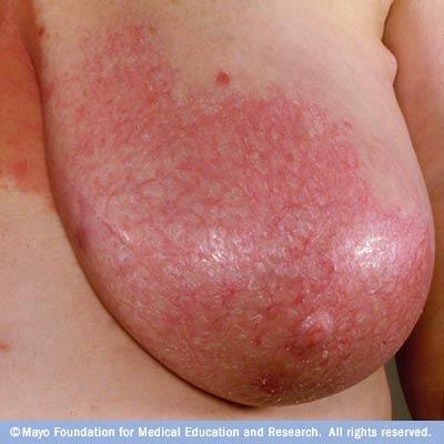 (inflammation of