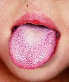 Scarlet fever The causative agent Streptococcus pyogenes Sign
