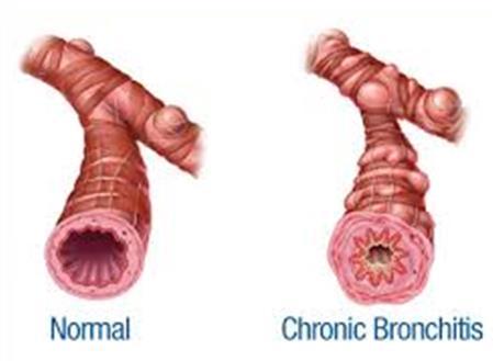 In chronic asthma, this inflammation can lead to scarring and the airways are not able to return to normal.