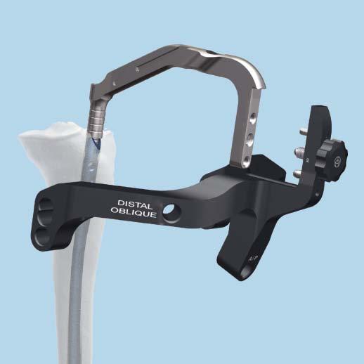 Proximal Locking Diaphyseal and Distal Segment Fractures continued 2 Mount aiming arm Instrument 03.010.