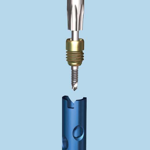 End Cap Insertion 1 Insert end cap Instruments 03.010.110 Cannulated StarDrive Screwdriver, T40 357.399 3.