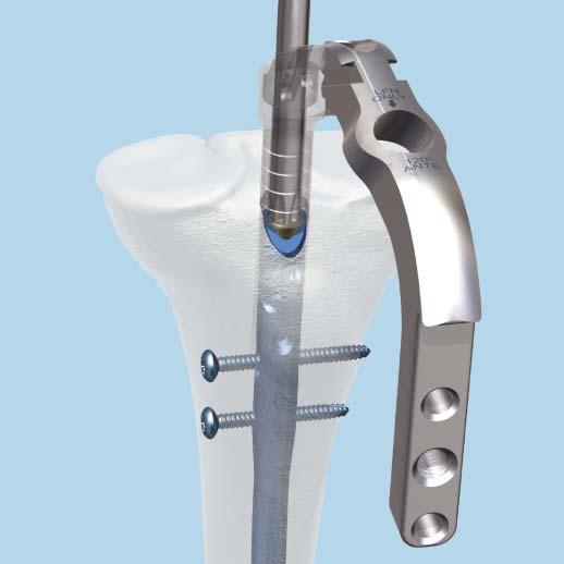 They protect nail threads from tissue ingrowth and extend the nail height if it is overinserted. The gold end caps lock the proximal oblique screw providing a stable fixed-angle construct.