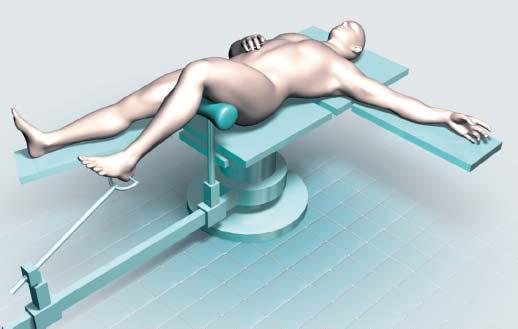 Optionally, the procedure can be performed on a fracture table with the leg placed in traction.