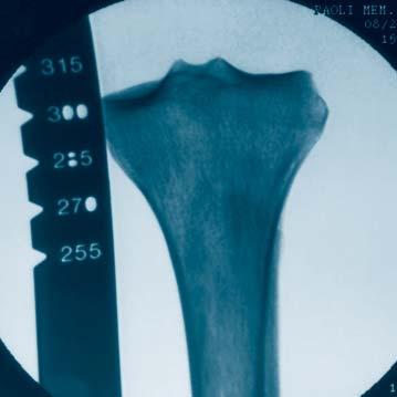 Position the C-arm for an AP view of the distal tibia. With long forceps, hold the radiographic ruler along the leg, parallel to and at the same level as the tibia.