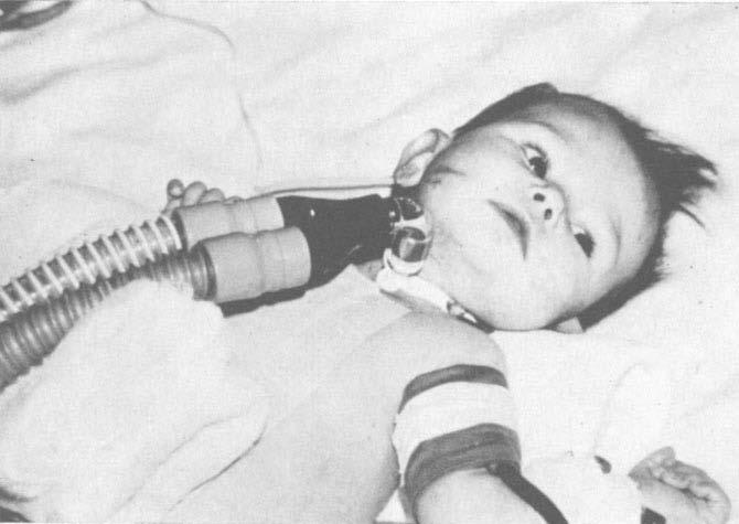 HALLER ET AL. FIG. 3. Child with Silastic tracheostomy tube attached to respirator. Note freedorn of head and ease of management.