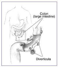 5.6 Diverticulosis and Diverticulitis Approximately 10% of people under 40, and 50% of people over 60 years old have a condition known as diverticulosis 1.