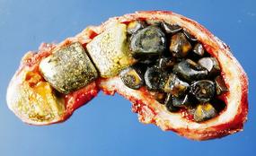 5.2 Gallstones It is estimated that up to 1 million Americans are hospitalized annually as a result of gallstones, making it the most common of all digestive diseases 1.