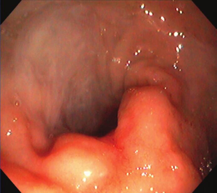 A: HIV-infected man with lymphogranuloma venereum presenting with rectal pain and bleeding for 1 month.