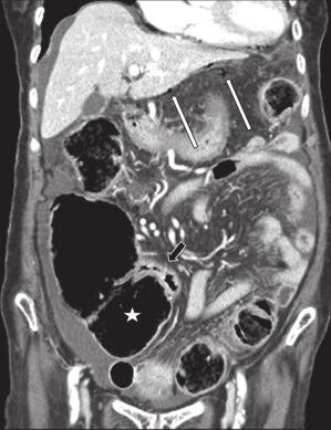 Identification of irregular, concentric wall thickening of the colon with contrast enhancement adjacent to the wall defect, as well as the findings described above, is needed for differentiation of a