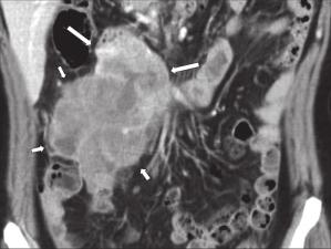 S W Kim, H C Kim and D M Yang (c) Figure 5. A 79-year-old female with a ruptured gastrointestinal stromal tumour (GIST).