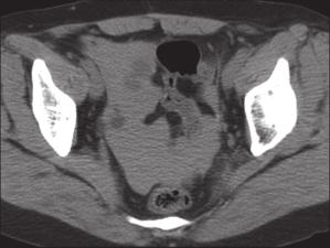 Multifocal lowattenuation areas, corresponding to necrosis, with septa are seen within the tumour. The patient refused surgery.