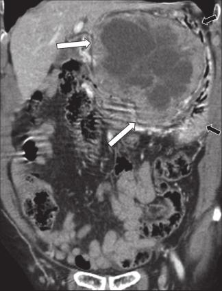 A large amount of high-attenuation ascites representing haemoperitoneum and clotted blood adjacent to the mass (asterisk) was also seen.