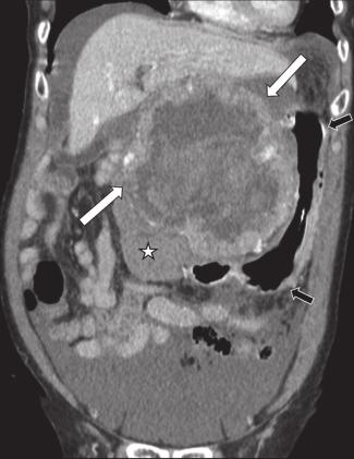 Perforated gastrointestinal metastasis The most common malignancy responsible for perforation of GI metastases is lung cancer, which tends to involve the small bowel [6, 15].