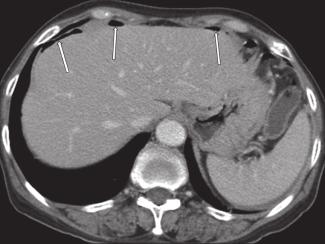 Pictorial review: Perforated tumours in the gastrointestinal tract Figure 7. A 79-year-old male with primary lung cancer (squamous cell carcinoma) presenting with acute abdominal pain.