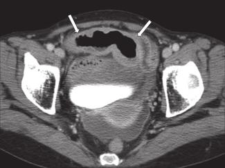 An irregular necrotic portion, connected to a mucosal ulceration, was found within the tumour (small arrows). commonly involve the GI tract [5].