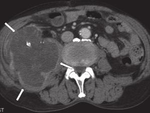 S W Kim, H C Kim and D M Yang the bowel wall, perforation can be presumed by observation of CT findings of pneumoperitoneum, peritoneal fat infiltration and ascites (Figures 8 and 9).