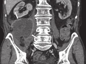(Figures 8 and 9). Dilated lumen of the bowel as a result of lymphoma is often observed on CT (Figure 8).