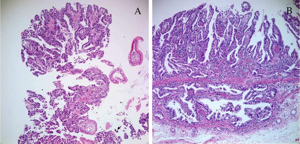 138 Gastric Carcinoma- New Insights into Current Management cases, and are usually depressed or ulcerated types types IIc or III [, ] Fig.