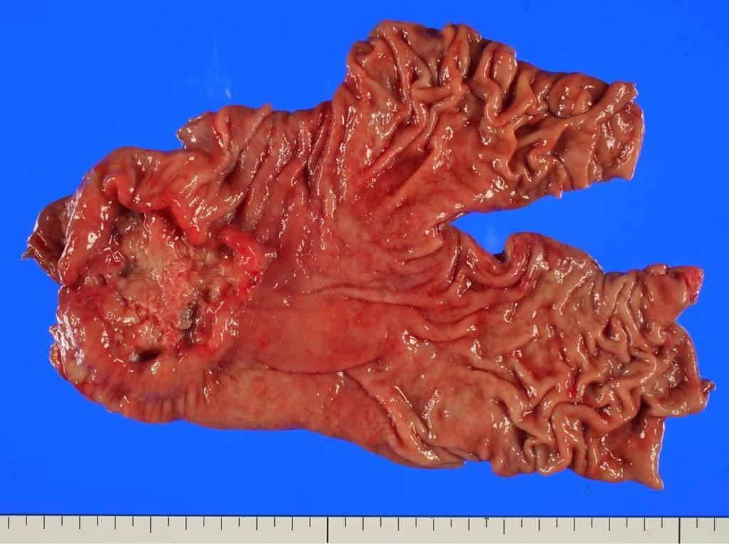 144 Gastric Carcinoma- New Insights into Current Management Figure 10.