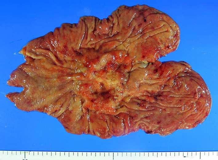 Fungating carcinoma of the stomach with extensive central ulceration involves the