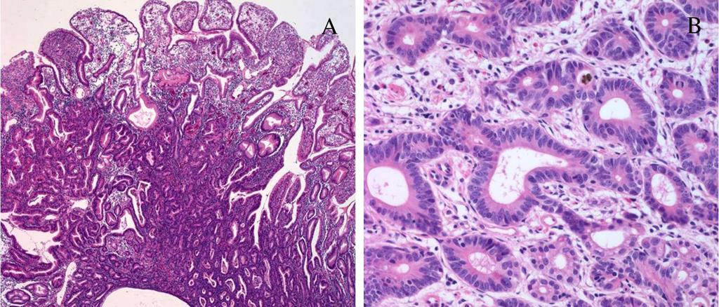 148 Gastric Carcinoma- New Insights into Current Management a tumor. Moderately differentiated tumors are intermediate with 50-95% of gland formation in a tumor.