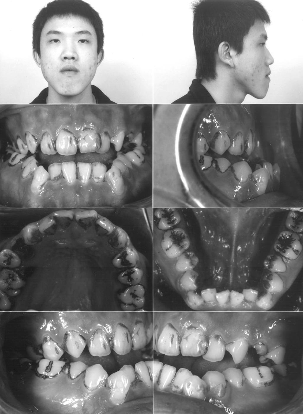 Chung-Chih Yu, et al 700 could be established easily without preoperative orthodontics. These patients were braced just before OGS, usually less than two weeks.