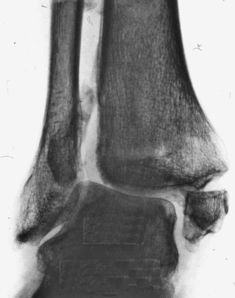 temporarily together. The congruence and function of the ankle were tested during the operation and per-operative radiological evaluation was performed.