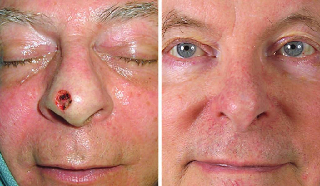 Volume 124, Number 3 Lower Third Nasal Reconstruction Fig. 4. A 57-year-old man with thin nasal skin underwent Mohs excision of a basal cell carcinoma on his nasal tip (left).