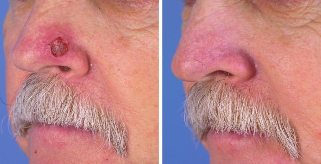 A 54-year-old man had a 7-mm alar defect after excision of a basal cell carcinoma (left). (Right) Patient at the 3-month follow-up visit following preauricular skin grafting.