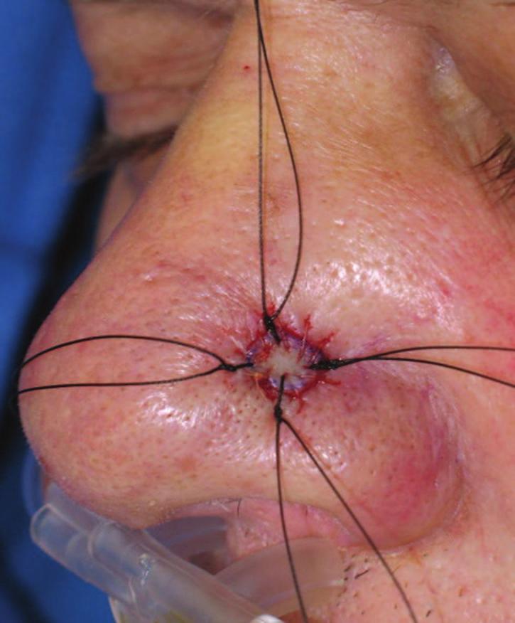 ) is placed at the center through the underlying tissue and then through the center of the graft.