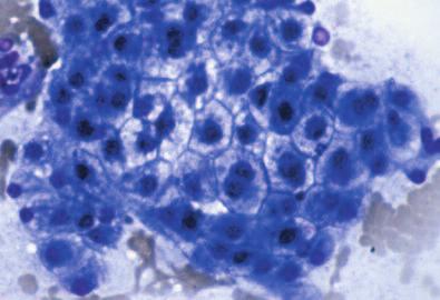 (Wright-Giemsa, original magnification 125) Figure 8 Glycogen accumulation in hepatocytes appears as diffuse, peripheral cytoplasmic clearing or foamy vacuolation that initially occurs in the