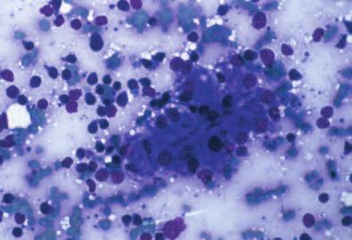 808 Small Animal/Exotics Compendium October 2002 Figure 15 Some feline hepatic lymphomas contain a neoplastic population of individually arranged small, well-differentiated lymphocytes.